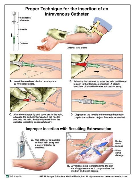 test the pump before inserting into bottle celon|Quiz: Administer Intermittent IV by Mini.